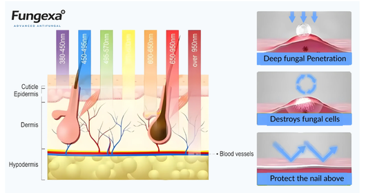 Fungexa™ - Nail Fungus Laser Device