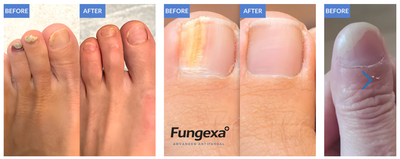 Fungexa™ - Nail Fungus Laser Device
