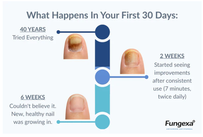 Fungexa™ - Nail Fungus Laser Device